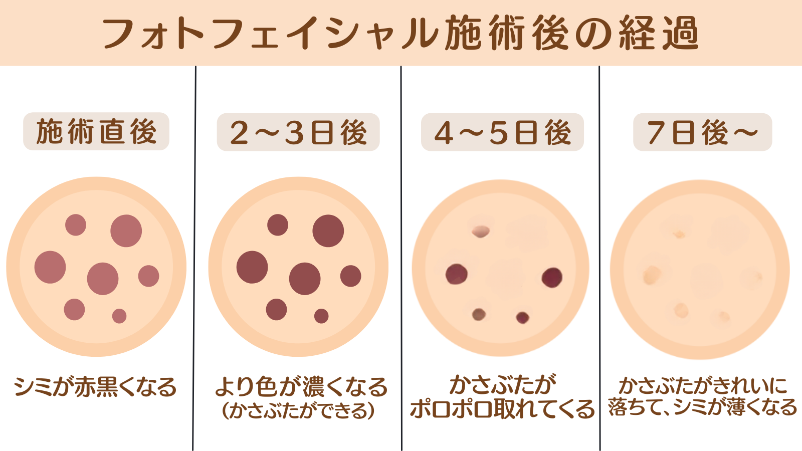 フォトフェイシャル施術後のダウンタイムの経過