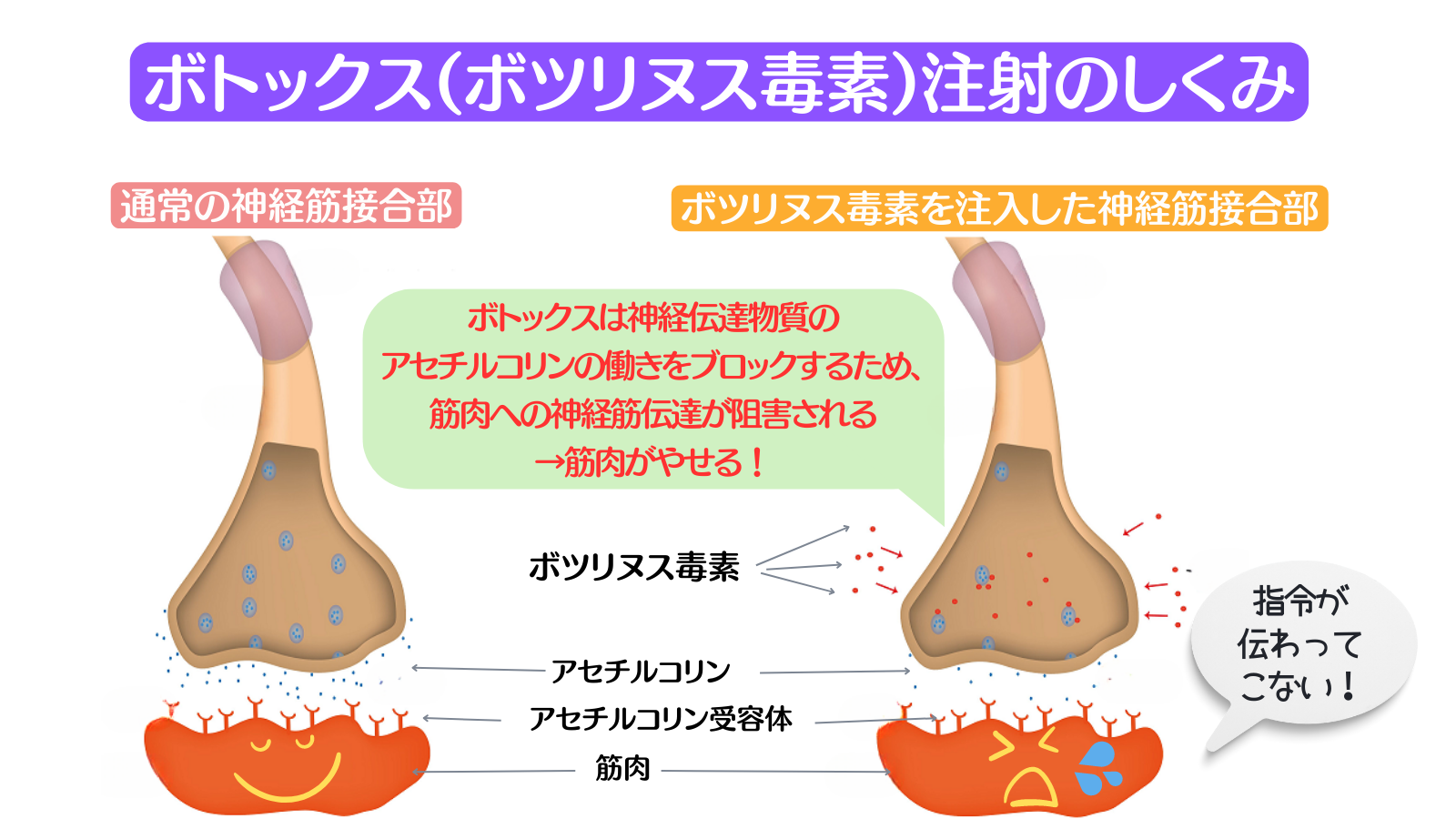 ボトックス注射のしくみ