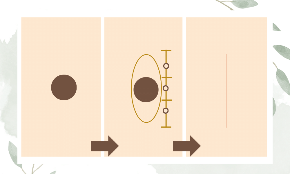 ほくろ切開法