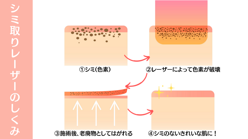 シミ取りレーザーのしくみ