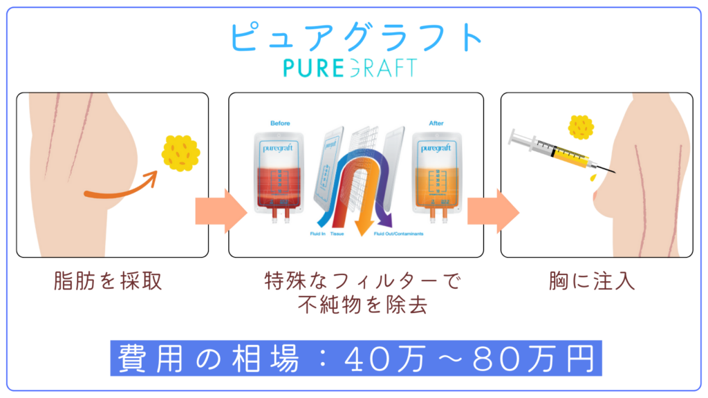 ピュアグラフトの費用相場と仕組み